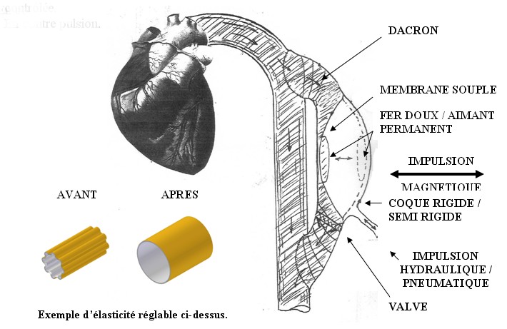 assistance cardiaque - cœur artificiel Principe de fonctionnement de l'assistance cardiaque / cœur artificiel